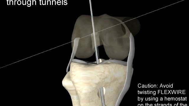 Анимация по пластике передней крестообразной связки смотреть онлайн