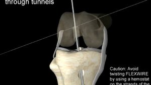 Анимация по пластике передней крестообразной связки