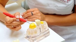 Как восстановить зуб, если остался только корень?