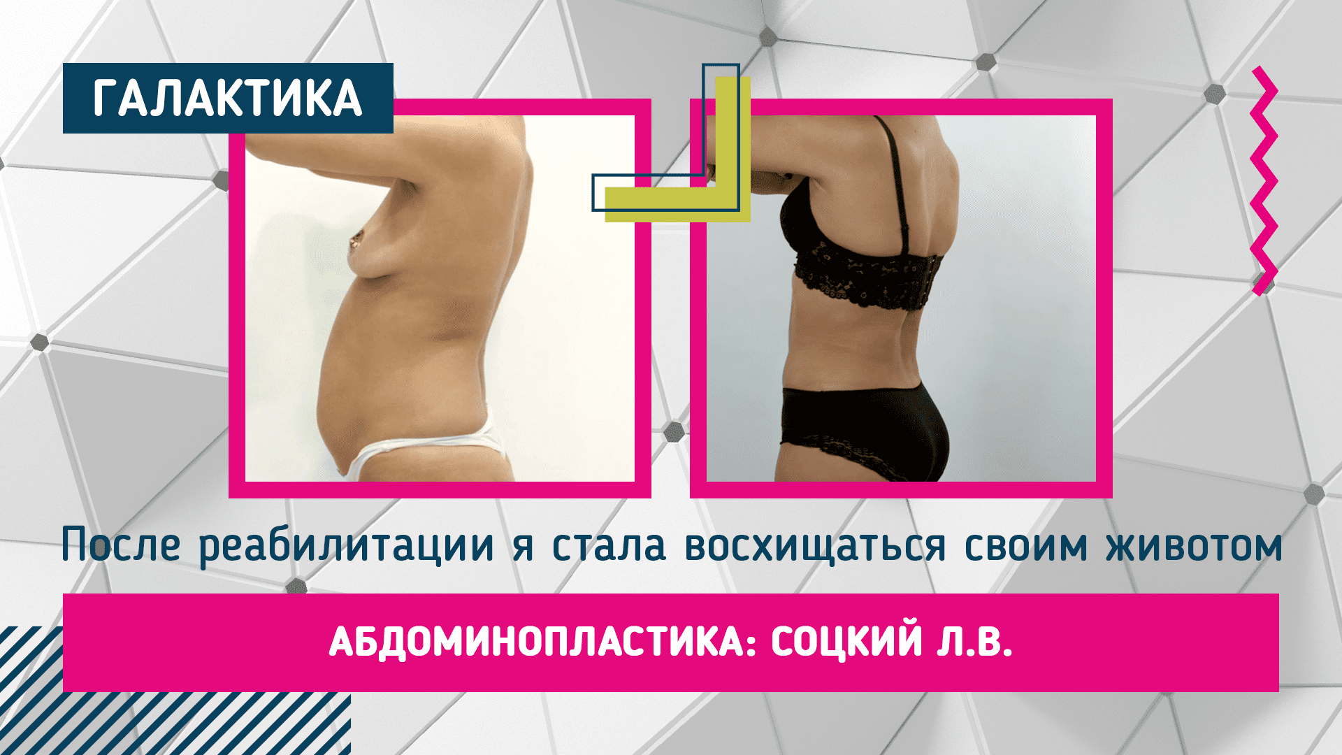 Абдоминопластика + липоскульптура: результат | Лев Соцкий #абдоминопластика #левсоцкий