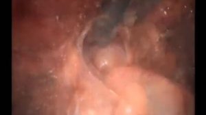 Вентральная грыжа