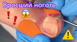 Вросший ноготь ????⚠️❗️