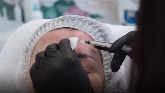 Корекція зморшок | Ботулінотерапія смотреть онлайн