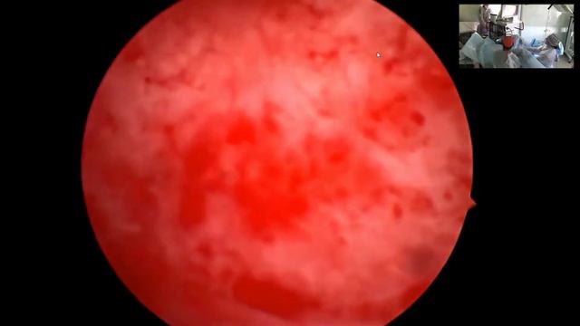 Гистерорезектоскопия матки - полиоктомия смотреть онлайн