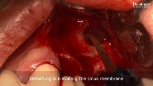 Sinus elevation using DASK Lateral approach