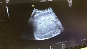 Биопсия печени под контролем УЗИ, в аккурат между сосудами!