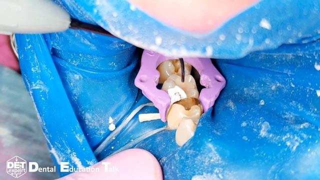 Вариант дистального разворота кольца для матриц адаптация матрицы тефлоном DET.expert & Sanctuary 4