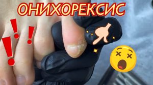 ОНИХОРЕКСИС ?⚠️???