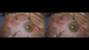 Supra choroidal Triamcinolon Lukan Mishev live stream