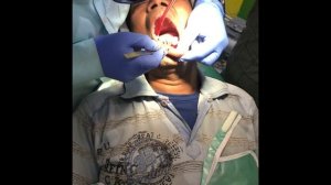 PYOGENIC granuloma || treatment and Excision || lower mandibular region