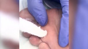 Удаление бородавки жидким азотом в "БЕТТА КЛИНИКА"