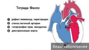 Тетрада Фалло. Как лечить тетраду Фалло.