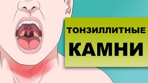 ТОНЗИЛЛИТНЫЕ КАМНИ – причины образования
