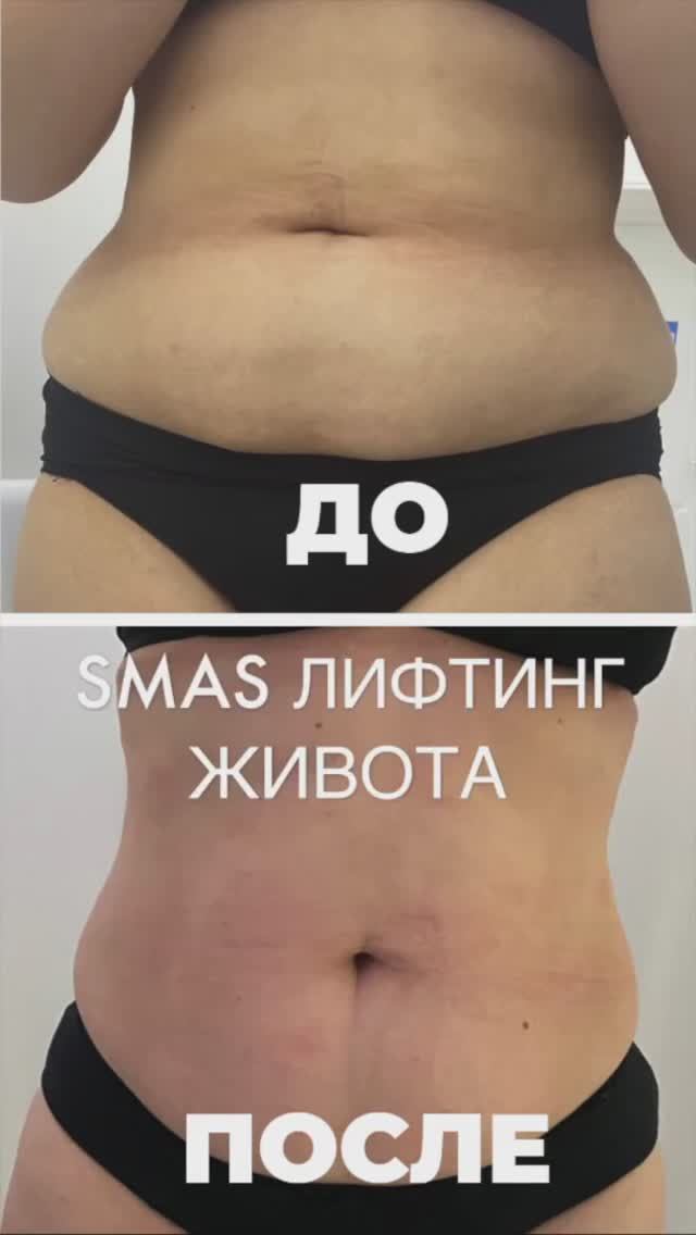 Как работает процедура SMAS ЛИФТИНГА?