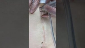 Лазерное удаление рубца