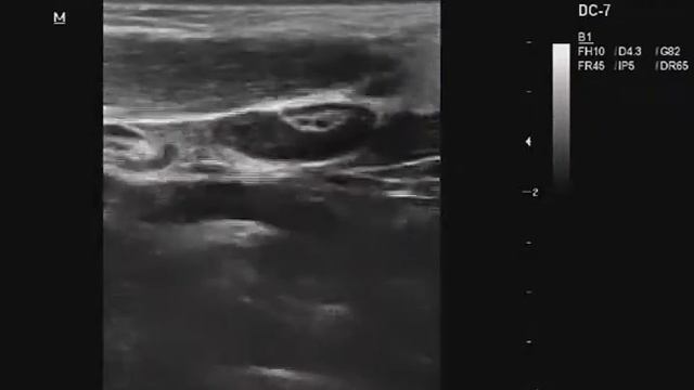 Петле-извитость ВСА смотреть онлайн