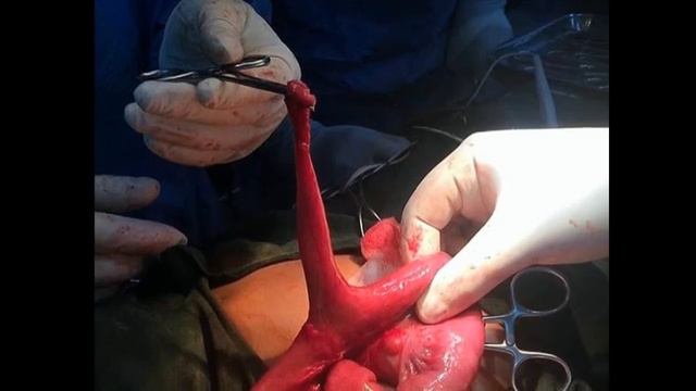 Дивертикул Меккеля смотреть онлайн