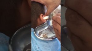 Черви (опарышы) в ушах у ребенка