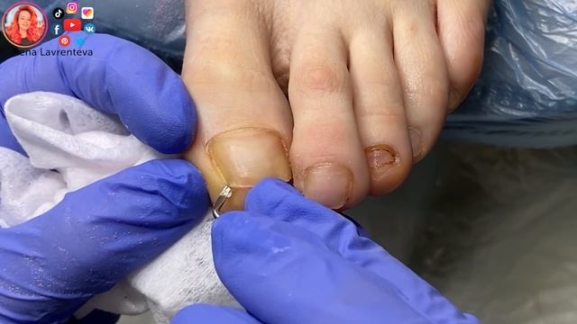Онихолизис ногтей / Синяк под ногтем на ноге смотреть онлайн