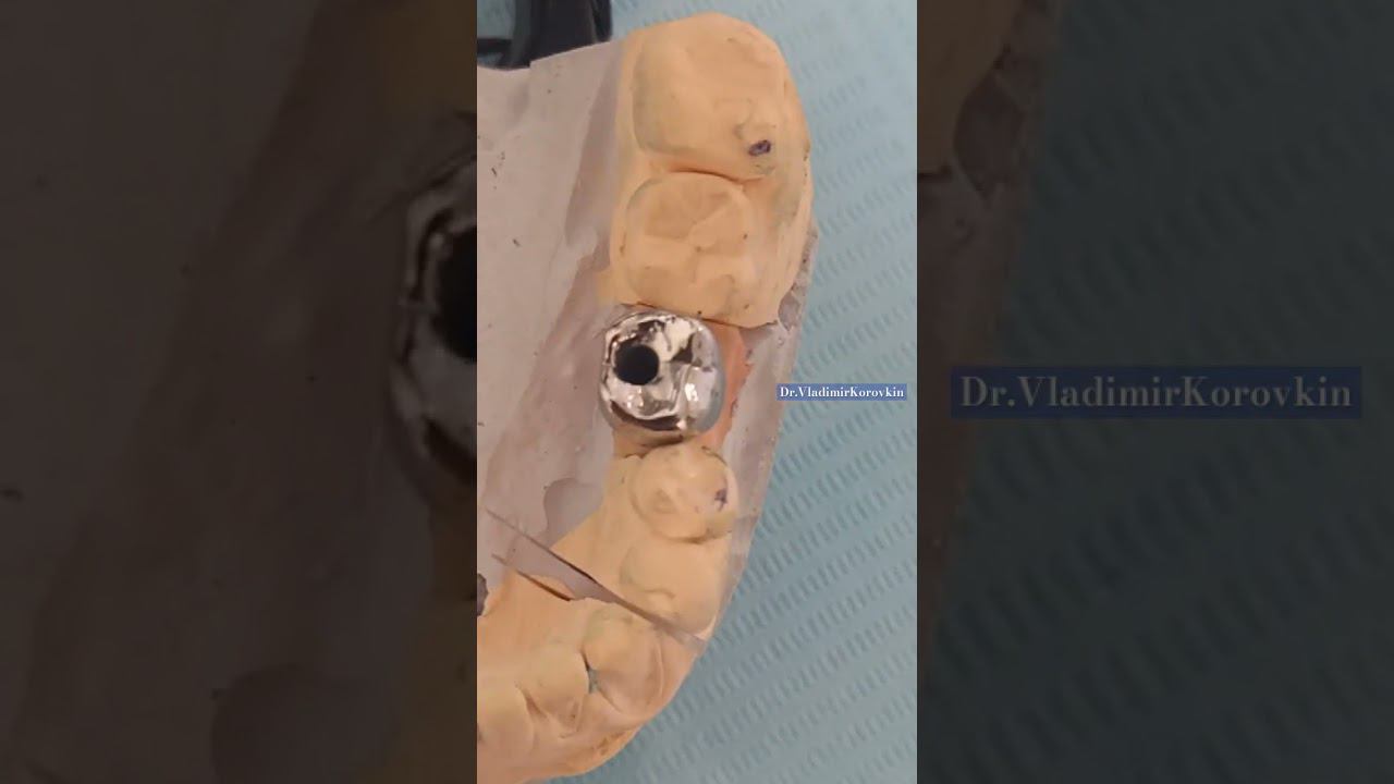 Perpentum dentium#2. Steel crown on implant. Screw type.