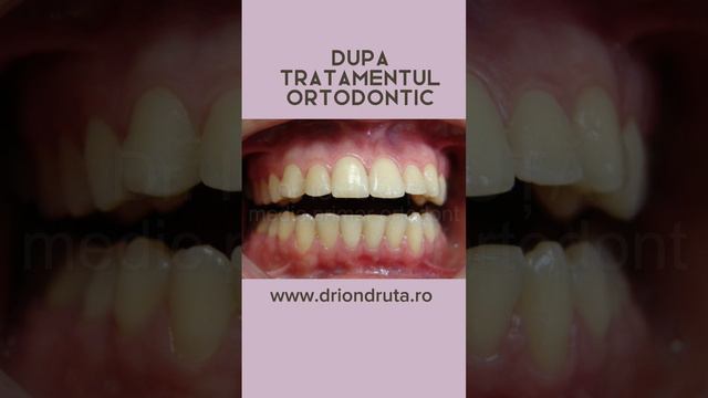 Caz rezolvat Dr. Ion Druta #tratamentortodontic #dintialiniaticorect #aparatdentar #medicortodont