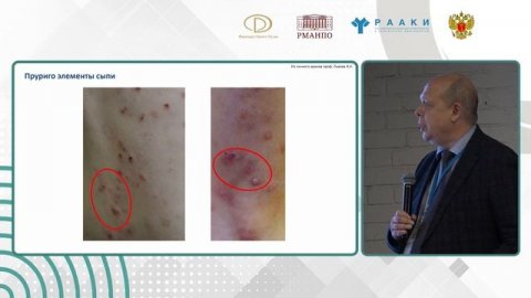 Симпозиум «Т2-ассоциированные заболевания от атопического дерматита до эозинофильного эзофагита»