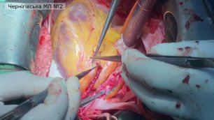 мамарокоронарне шунтування 1 протезування аортального клапана бандажування висхідного відділу аорти