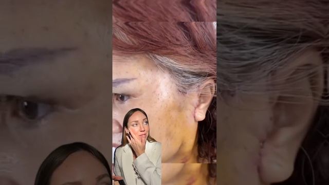 Паутинная Подтяжка лица #подтяжкалица #нити #лифтинглица