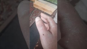 Перелом большого пальца