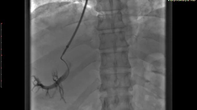 Трансъюгулярная пункция притока воротной вены смотреть онлайн