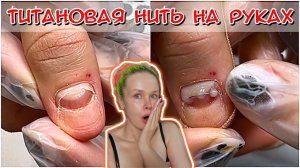 Титановая нить на руках / Травма ногтя / Клиент пропал на 3 месяца! #nails #ногти #маникюр