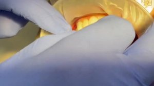 Временные коронки, всё на 4 имплантах. implantati.ru