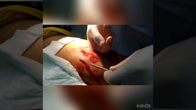 Вскрытие флегмоны правой ягодичной области