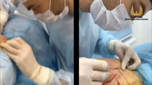 Подтяжка нижней трети лица, создание шейно-подбородочного угла