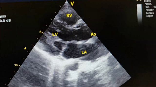 Эхокардиография, узи сердца, длинная ось левого желудочка смотреть онлайн