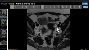 Introduction to Gyne MRI (Female Pelvis): Case-Based Course