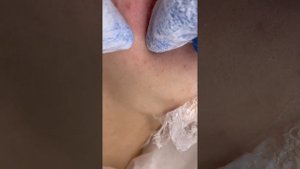 Чистка лица. Избавляемся от закрытых комедонов и черных точек.