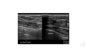 ЛЕКЦИЯ 5. УЗИ АНАТОМИЯ МОЛОЧНЫХ ЖЕЛЕЗ