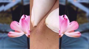 Выдавливание чёрных точек НОВОЕ! Удаление чёрных точек за ухом. p20