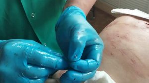 Удаление большого доброкачественного новообразования. Липома спины.