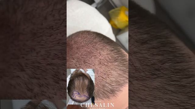 Две недели после пересадки волос в зону макушки. Плановый осмотр после трансплантации волос. смотреть онлайн