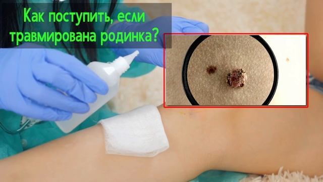 Что будет если повредил родинку? Лечить или удалять? смотреть онлайн