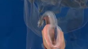 Установка Ларингеальной маски Portex