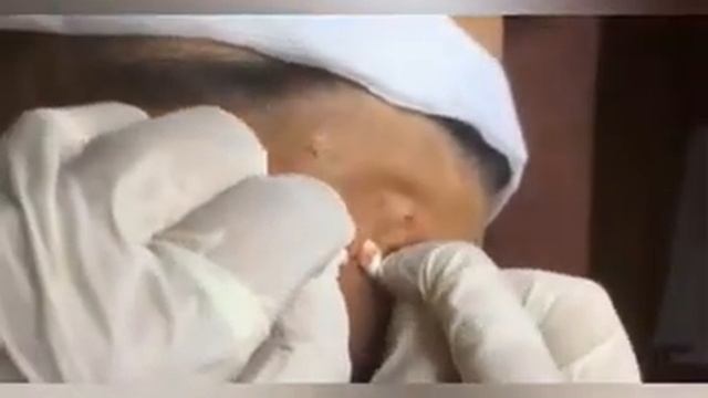 Давим прыщи с брызгами