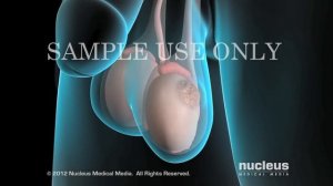 Medical Animation: Testicular Cancer