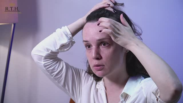 Non shaving FUE метод трансплантации волос.