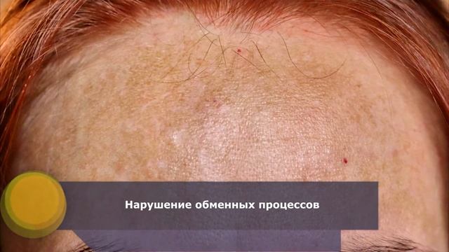 Причины пигментации кожи | Почему происходит пигментация кожи