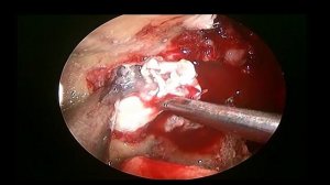 PTERYGOPALATINE FOSSA AND MUCOR