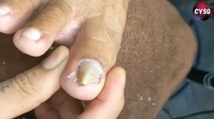 Pedicure Nails Ingrown Toenail // Педикюр Вросший Ноготь