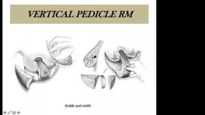 Principles of Reduction Mammoplasty